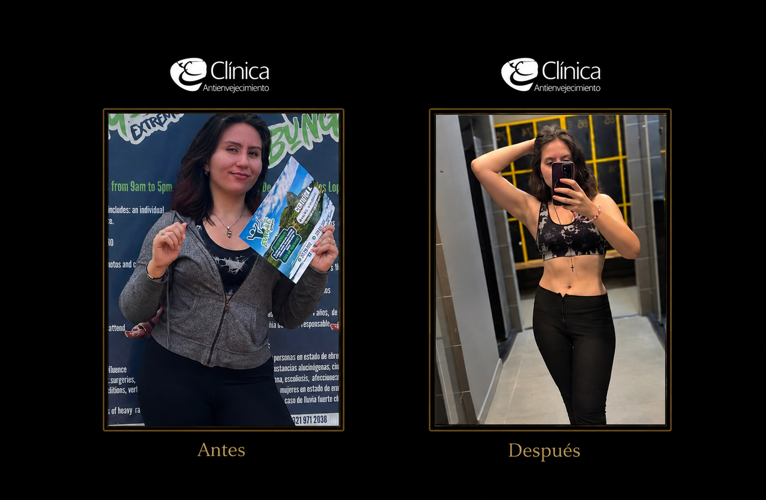 Hidrolipoclasia — antes y después