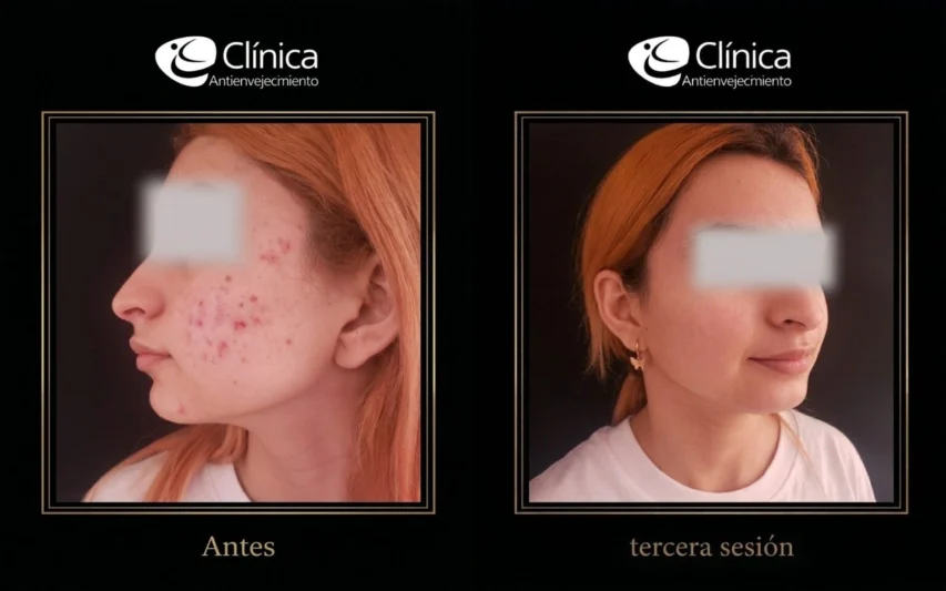 Plasma Facial — antes y después