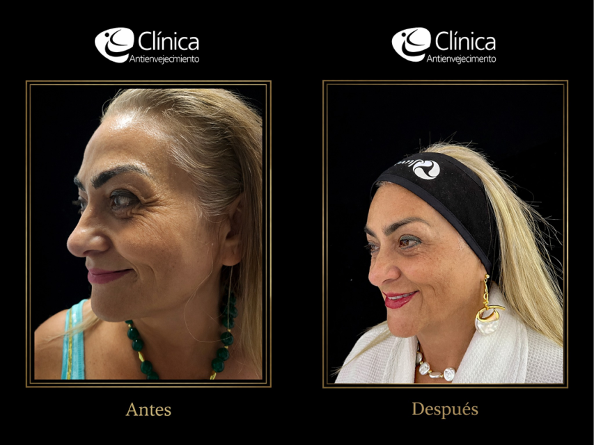 Rejuvenecimiento Facial — antes y después