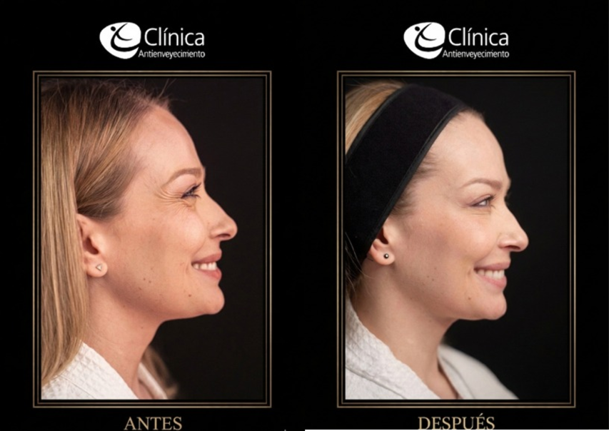 Rejuvenecimiento Facial — antes y después